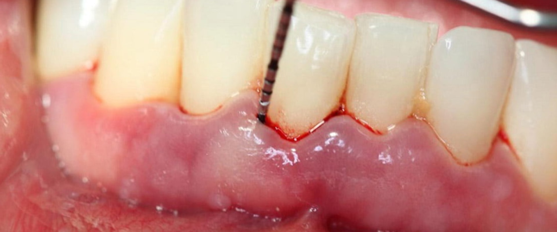 How long does it take for gums to reattach after deep cleaning?