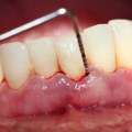 How long does it take for gums to reattach after deep cleaning?