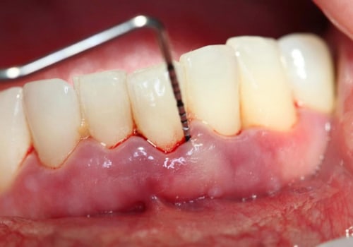 How long does it take for gums to reattach after deep cleaning?